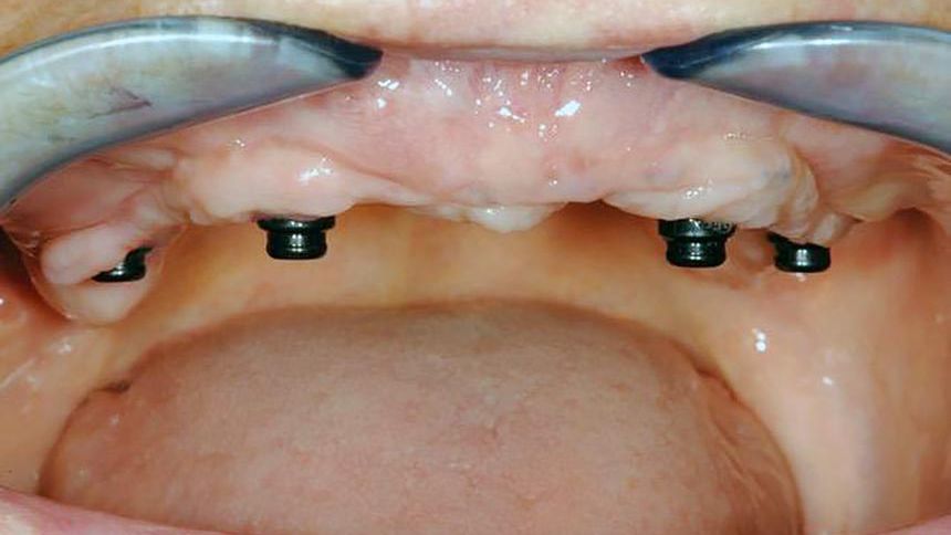 edentulous patients